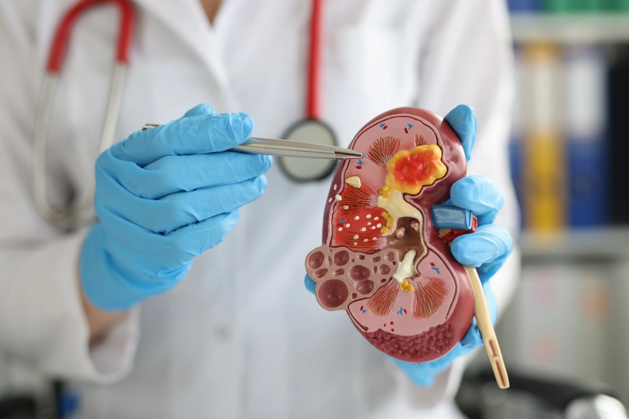 Doctor holding kidney model and pointing to kidney disease illustration